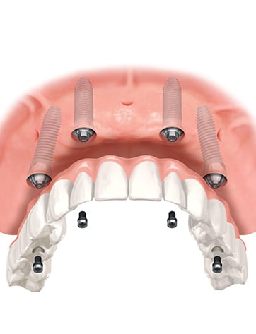 Имплантация верхних зубов
