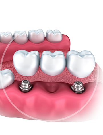 Имплантация жевательных зубов